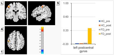 Differential responses from the left postcentral gyrus, right middle frontal gyrus, and precuneus to meal ingestion in patients with functional dyspepsia